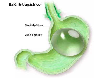 Balon-intragastrico-400-300